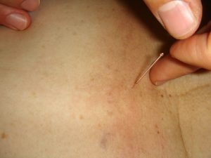 Akupunktur gegen Schmerzen