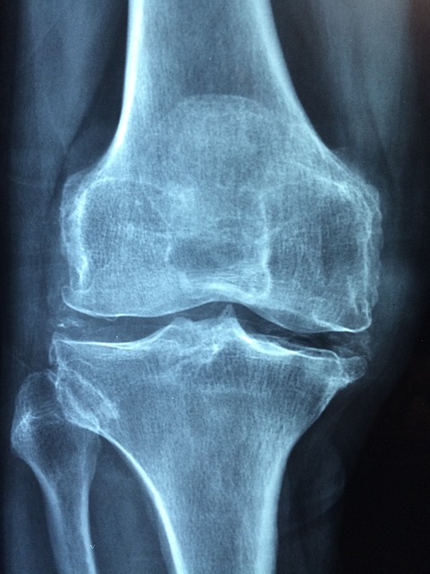 osteoporose behandlung