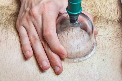 Schröpfen und wo es hilft