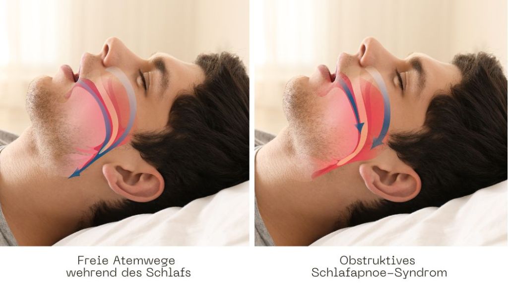 Freie Atemwege während des Schlafs